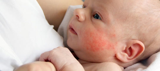 Eczéma du bébé